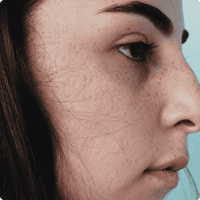 Dullness &Uneven Texture